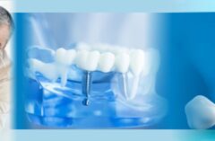 Implants Dental Clinic Bopal by best dentist in bopal to treat missing teeth