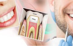 root canal treatment dental clinic bopal for teeth infection by best dentist in bopal