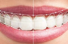 smile desing bopal by best dentist in bopal