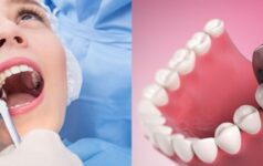 Teeth extraction Dental clinic bopal for broken teeth or infection