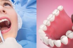 Teeth extraction Dental clinic bopal for broken teeth or infection