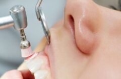 teeth Scaling Dental Clinic Bopal for removing tartar its also teeth cleaning procedure