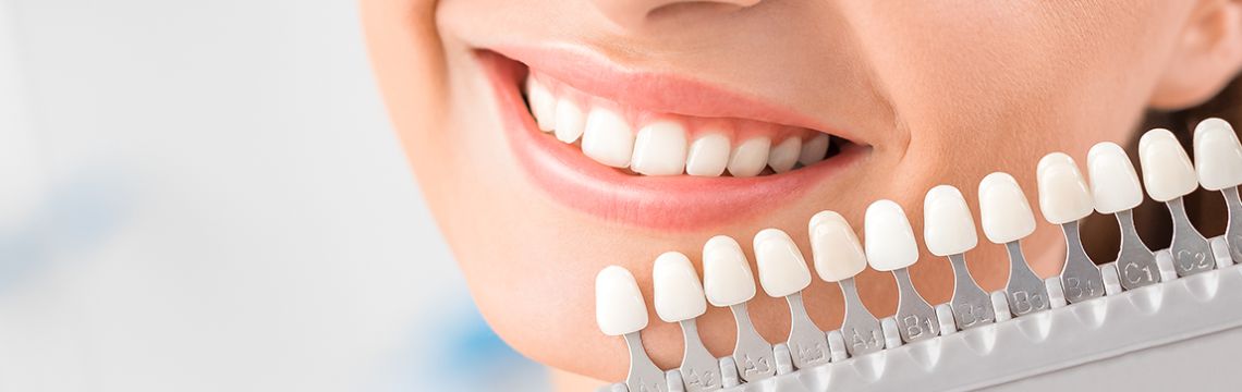 Teeth Whitening Dental Clinic bopal for bright smile to impress everybody